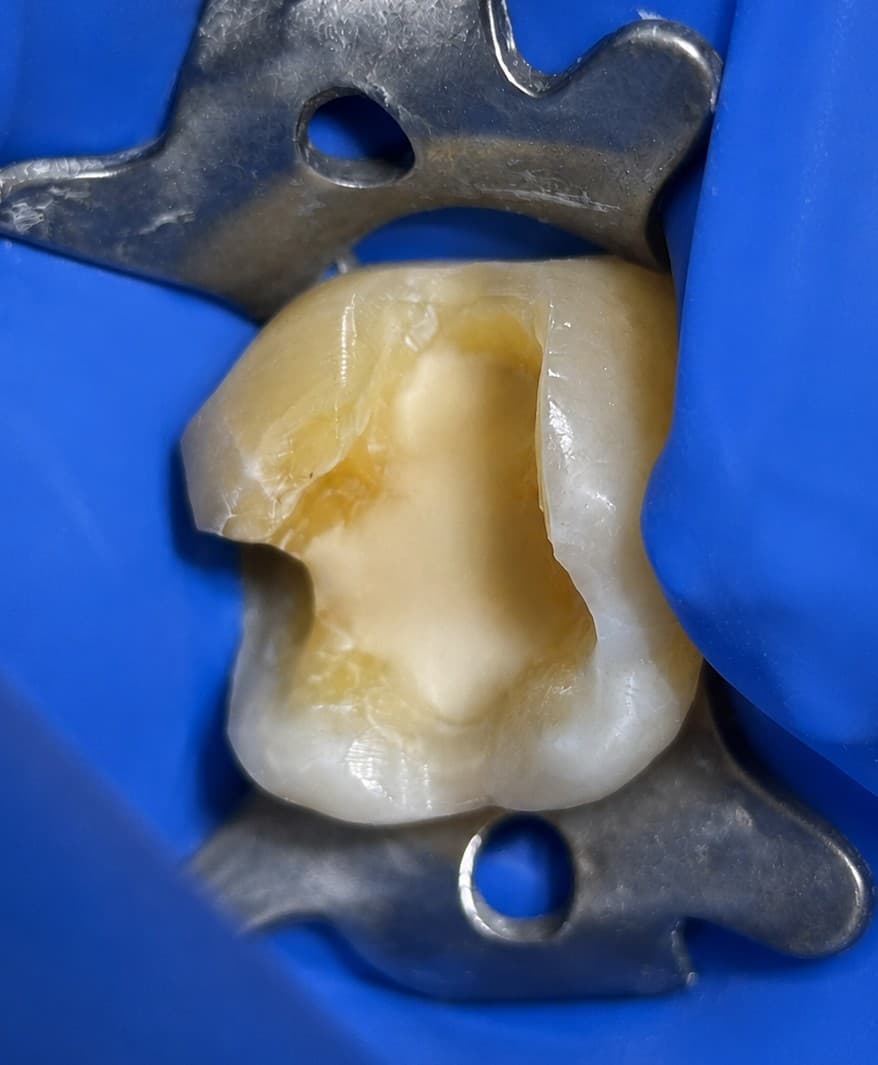 Antes de restauración dental