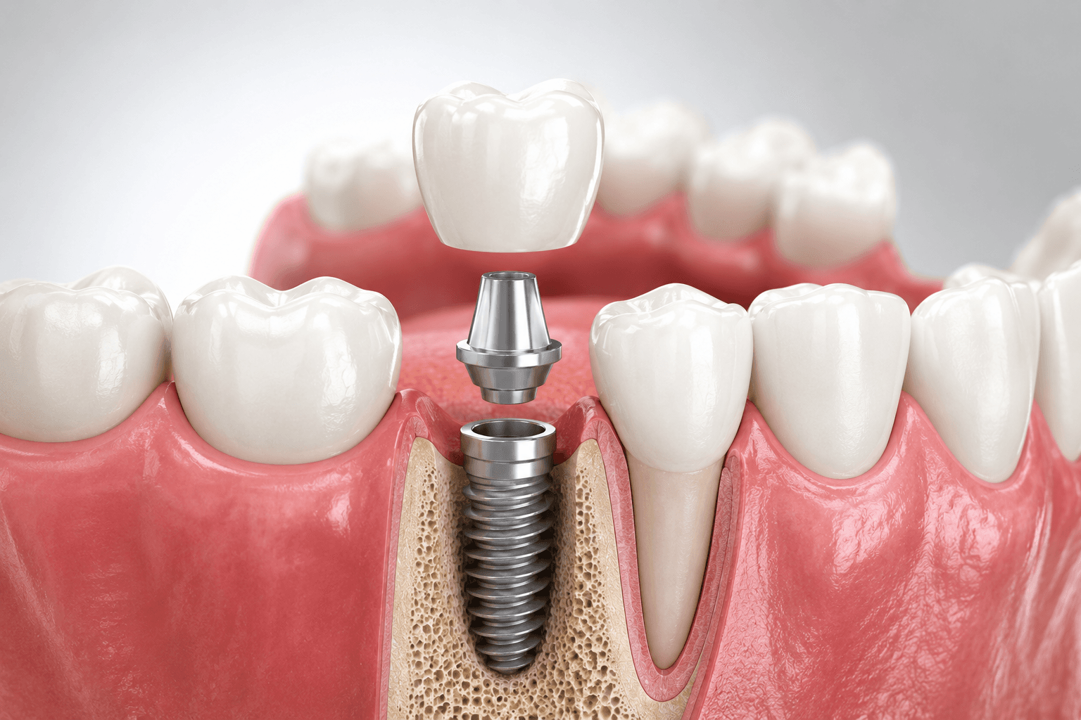 Implantes dentales